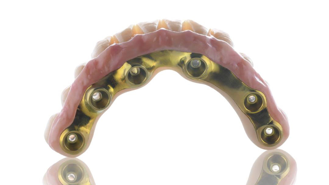 Dental model with gold fixtures on a white background